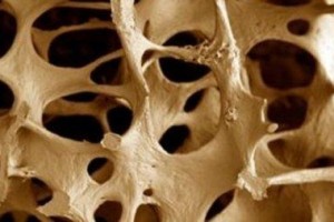 Vida e Saúde: Saiba como prevenir a Osteoporose