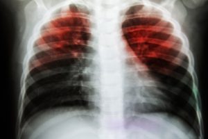 Estudo revela compostos que podem combater a tuberculose